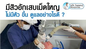มีสิวอักเสบเม็ดใหญ่ ไม่มีหัว ขึ้น ดูแลอย่างไรดี ?